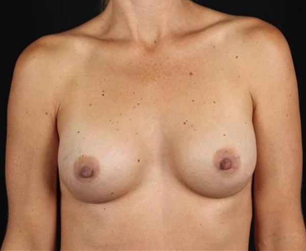 Breast Augmentation