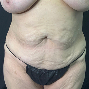 Tummy Tuck