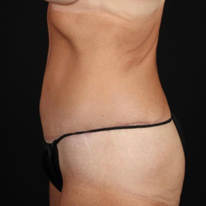 Tummy Tuck