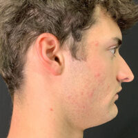 Rhinoplasty