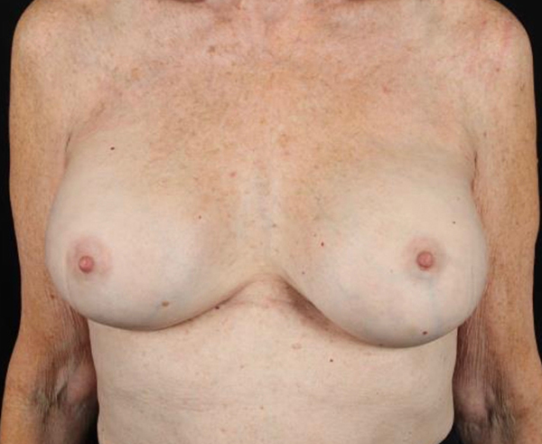 Breast Augmentation