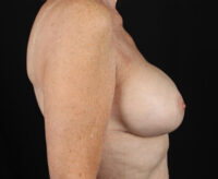 Breast Augmentation