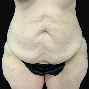 Tummy Tuck