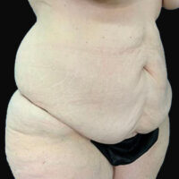 Tummy Tuck
