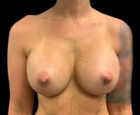 Breast Augmentation