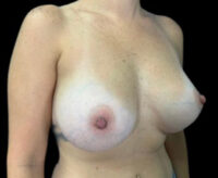 Breast Augmentation