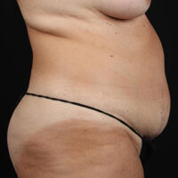 Tummy Tuck