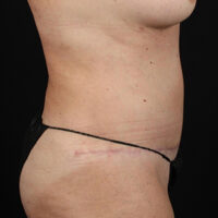 Tummy Tuck