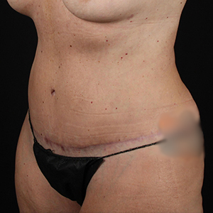 Tummy Tuck