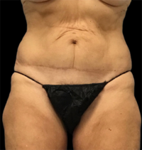 Tummy Tuck