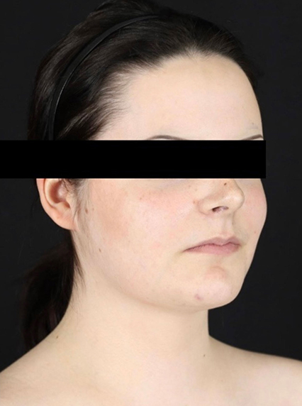 right oblique view after liposuction