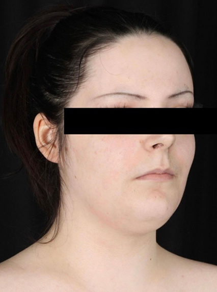 right oblique view before liposuction