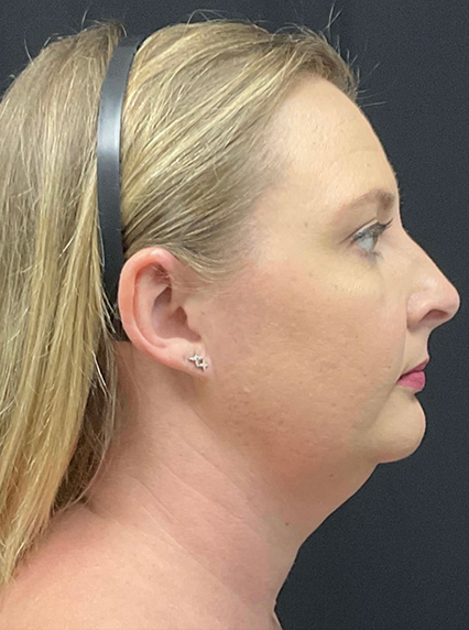 right side view before liposuction