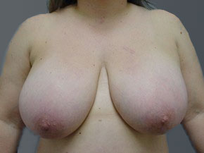 Breast Reduction Ormond Beach