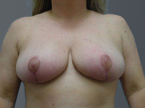 Breast Reduction Results Ormond Beach