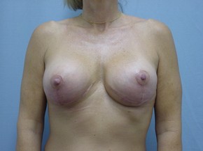 Breast Revision Surgery Results Ormond Beach