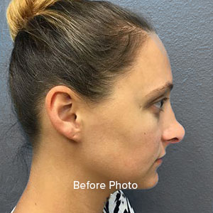 Non-surgical nose job