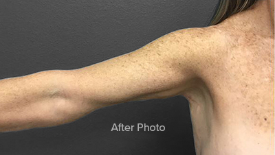 Arm Lift Brachioplasty Results Ormond Beach