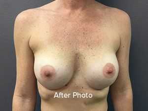 Types of breast implants - Breast Augmentation