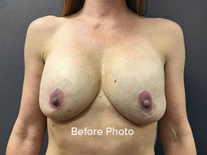 Breast Lift Ormond Beach