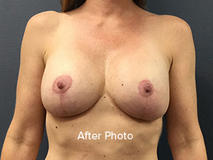 Breast Lift Results Ormond Beach