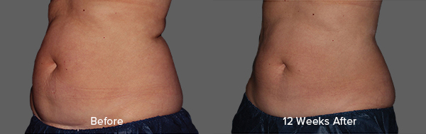 CoolSculpting Result