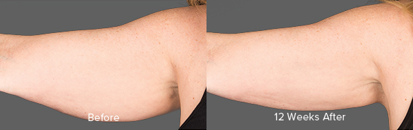 CoolSculpting Result