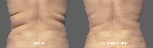 CoolSculpting Result