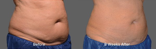 CoolSculpting Result