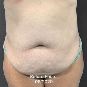 Mini tummy tuck