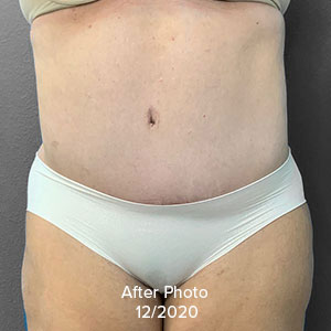 Abdominoplasty