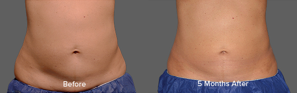 CoolSculpting Result