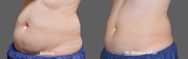 CoolSculpting Result