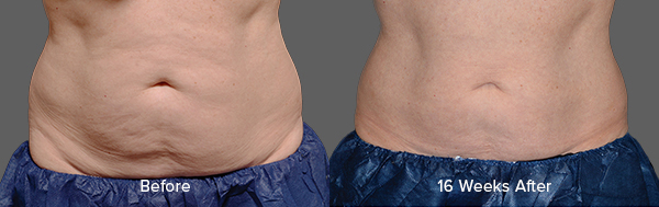 CoolSculpting Result