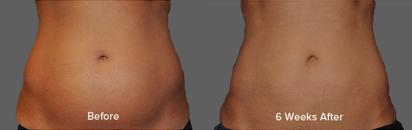 CoolSculpting Result