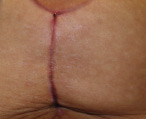 Breast reduction scar