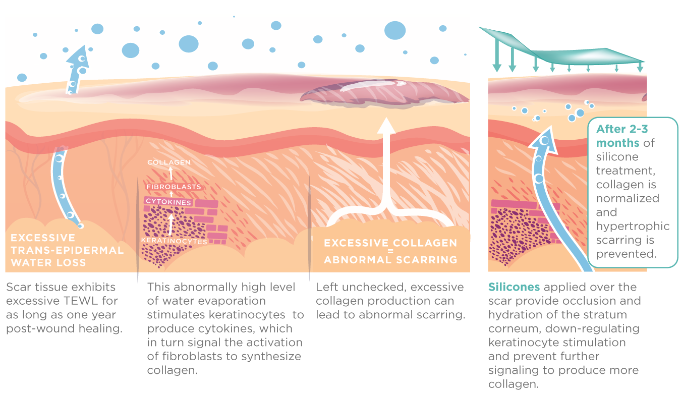 Diagram illustrating skin layers and treatment options